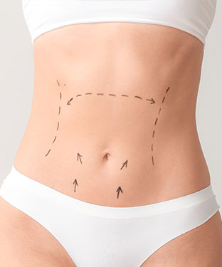 All About Tummy Tuck Scars  Spring Ridge Plastic Surgery