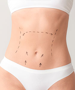 Abdominoplasty - Partridge Plastic Surgery in North Brunswick, NJ and Princeton, NJ