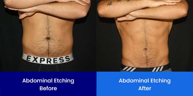 Abdominal Etching - Before and After