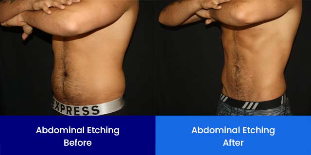 Abdominal Etching - Before and After