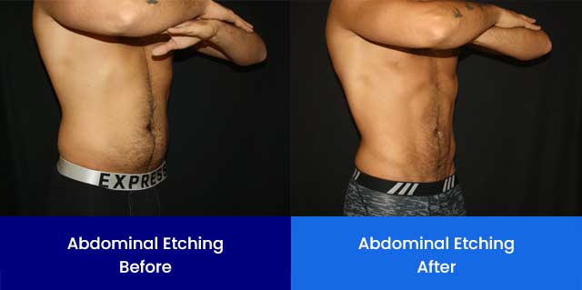 Abdominal Etching - Before and After