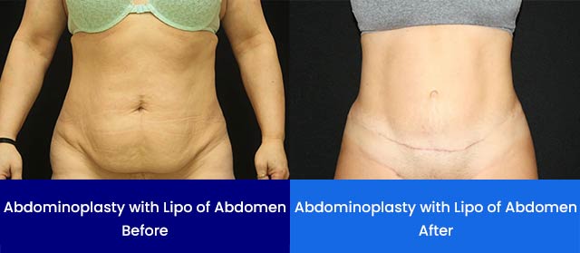 Abdominoplasty with Lipo of Abdomen - Before and After