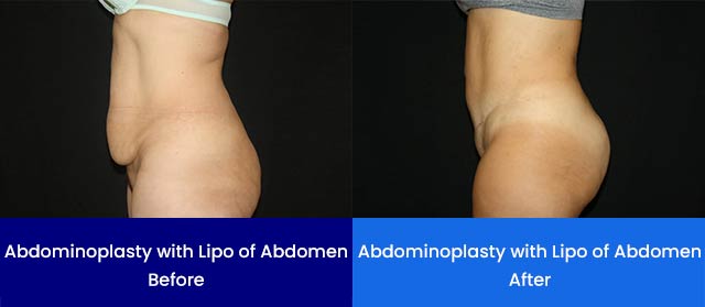 Abdominoplasty with Lipo of Abdomen - Before and After