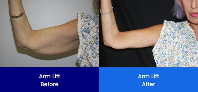 Arm Lift - Before and After