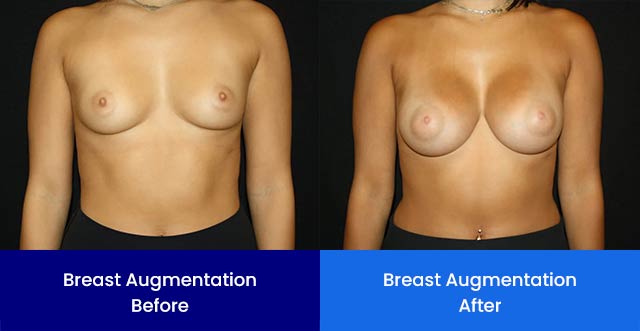 Breast Augmentation - Before and After