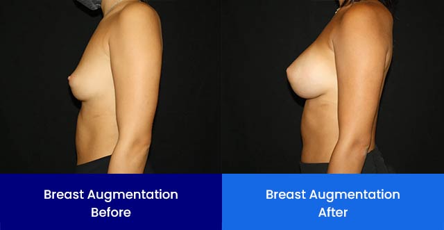 Breast Augmentation - Before and After