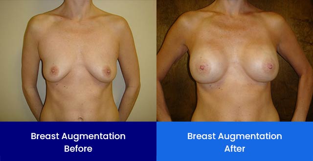 Breast Augmentation - Before and After