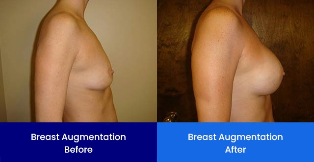 Breast Augmentation - Before and After