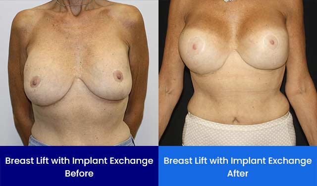 Breast Lift with Implant Exchange - Before and After