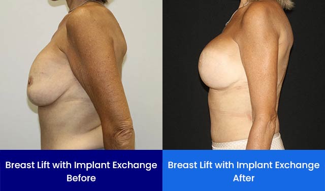 Breast Lift with Implant Exchange - Before and After