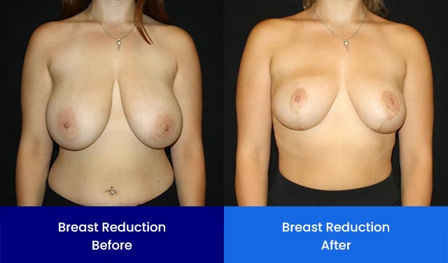 Breast Reduction - Before and After