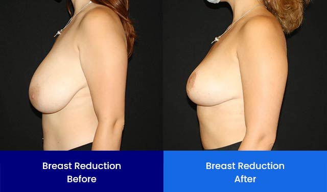 Breast Reduction - Before and After