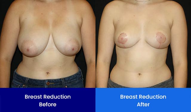 Breast Reduction - Before and After