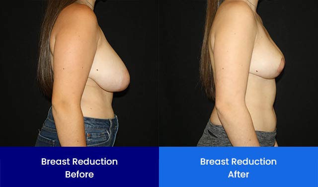 Breast Reduction - Before and After