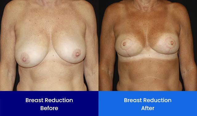 Breast Reduction - Before and After