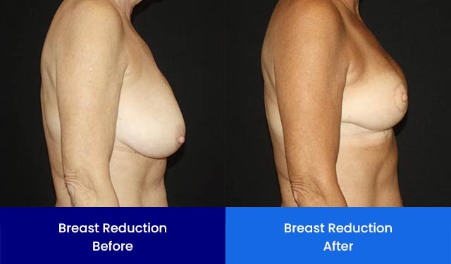 Breast Reduction - Before and After