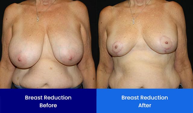 Breast Reduction - Before and After