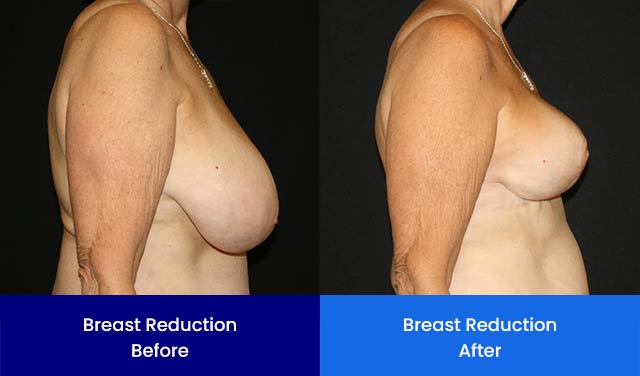 Breast Reduction - Before and After