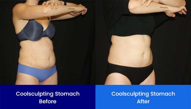 Coolsculpting Stomach - Before and After