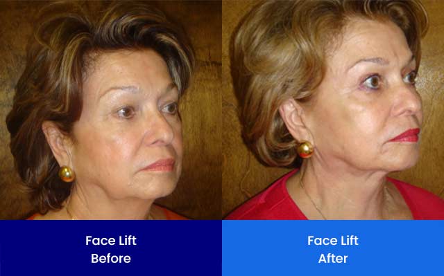 Face Lift - Before and After