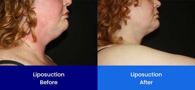 Liposuction - Before and After