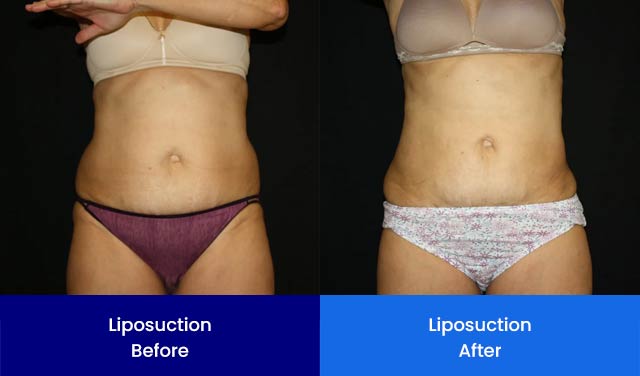 Liposuction - Before and After