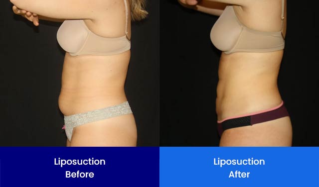 Liposuction - Before and After