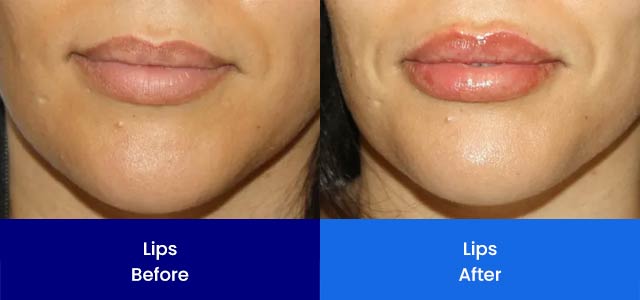 Lips - Before and After