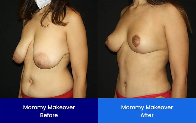 Mommy Makeover - Before and After