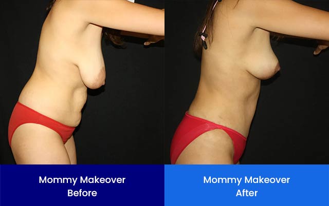 Mommy Makeover - Before and After