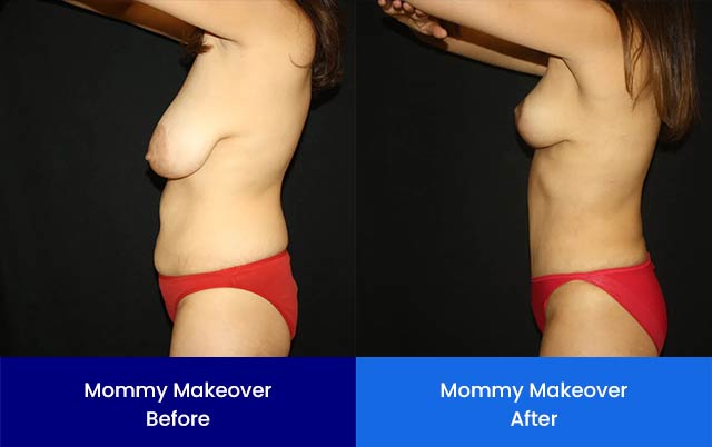 Mommy Makeover - Before and After