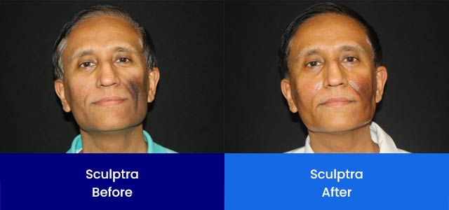 Sculptra - Before and After