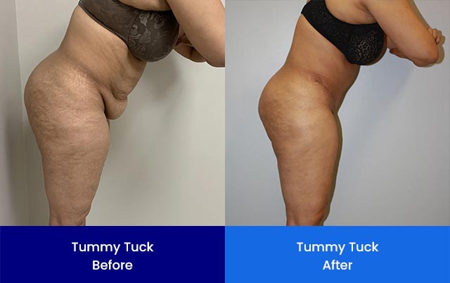 Tummy Tuck - Before and After