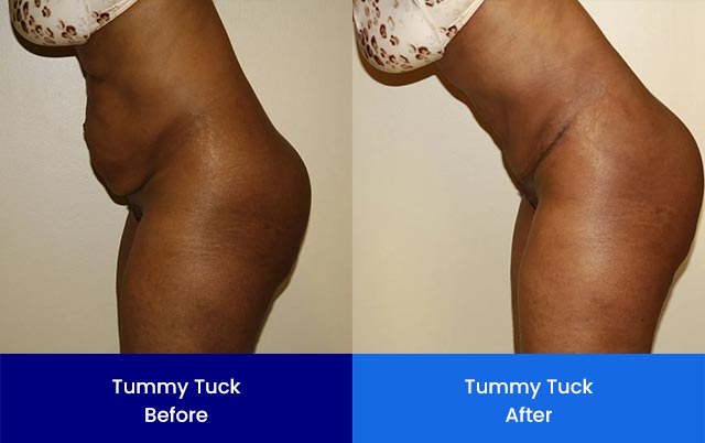 Tummy Tuck - Before and After