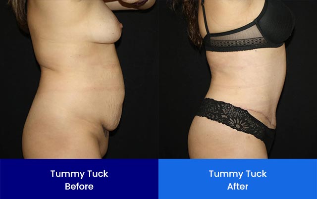 Tummy Tuck - Before and After