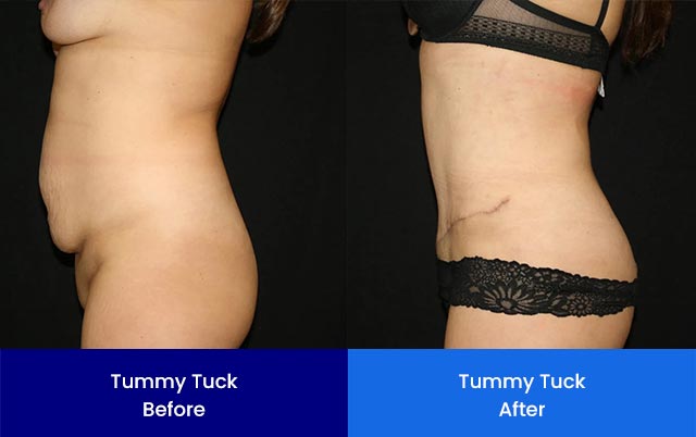 Tummy Tuck - Before and After