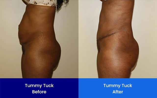 Tummy Tuck - Before and After