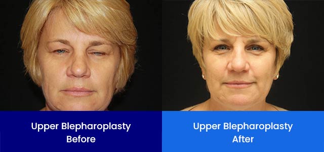 Upper Blepharoplasty - Before and After