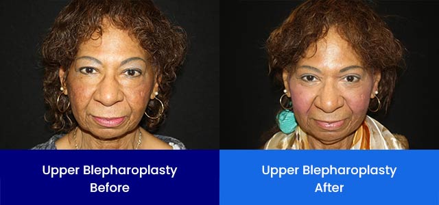 Upper Blepharoplasty - Before and After