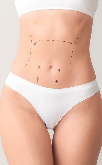 Abdominoplasty - Partridge Plastic Surgery in New Jersey