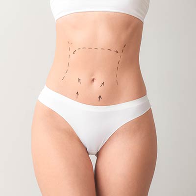 Abdominoplasty - Partridge Plastic Surgery in New Jersey