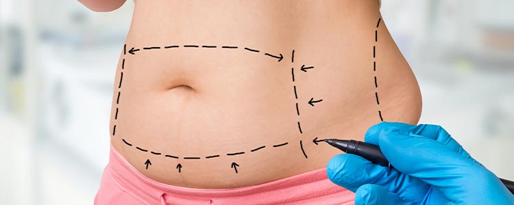 Cost of Tummy Tuck Procedure Near Me in Princeton, NJ