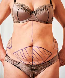 Abdominoplasty - Partridge Plastic Surgery in North Brunswick, NJ and Princeton, NJ