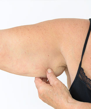 Arm Lift - Partridge Plastic Surgery in North Brunswick, NJ and Princeton, NJ