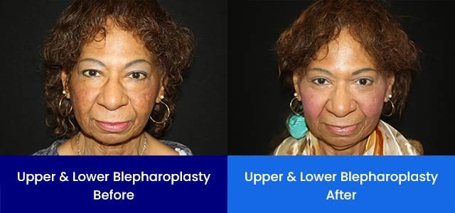 Upper and Lower Blepharoplasty - Before and After Upper and Lower Blepharoplasty - Before and After